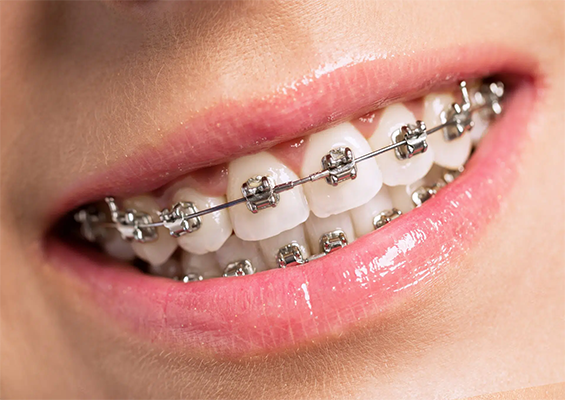 Braces treatment in Borivali Mumbai