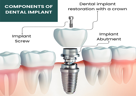 componenets of dental implants