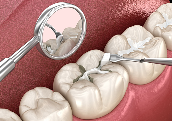 best tooth filing dental clinic in borivali mumbai